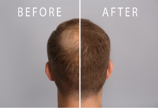 Hair Restoration